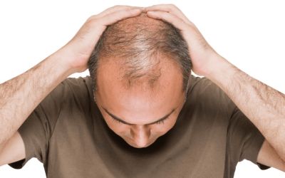 چگونه ریزش موی مردانه را کنترل کنیم؟