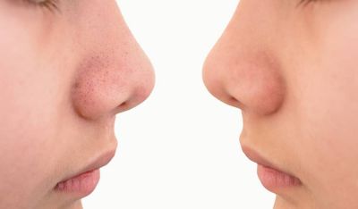 درمان جوش سر سیاه