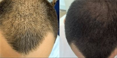 میکرواسکالپ چیست؟