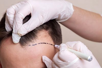 تبلیغ کاشت مو با 5 نمونه متن خلاقانه!